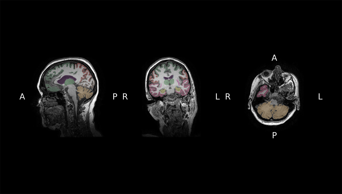 Brain Age