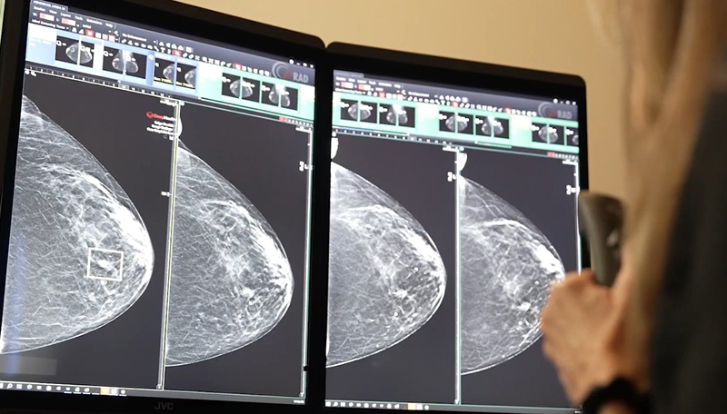 Building Patient Trust in AI-Powered Breast Screening