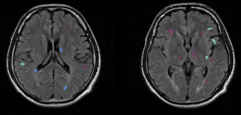How AI is Transforming Neurodegenerative Disease Detection and Management
