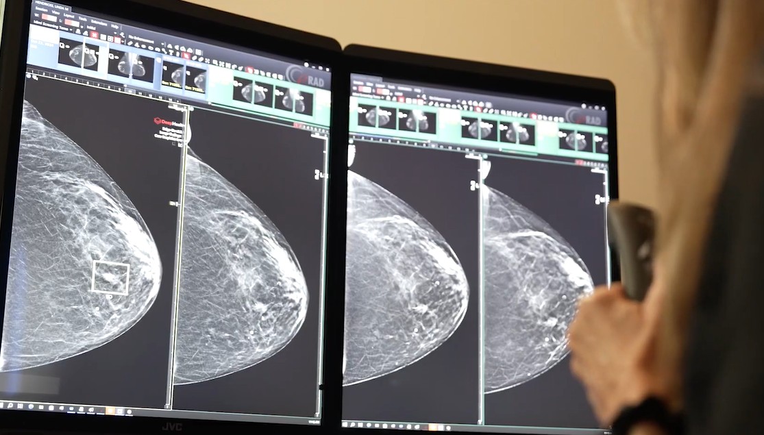 Building Patient Trust in AI-Powered Breast Screening